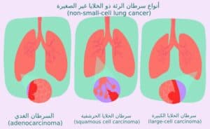أنواع سرطان الرئة