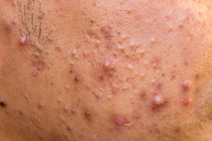 حب الشباب العقدي (Nodules)