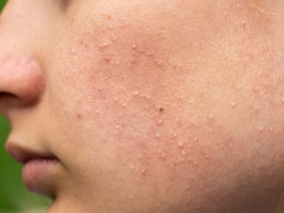 حب الشباب الفطري (Fungal acne)