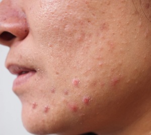 حب الشباب الهرموني (Hormonal acne)