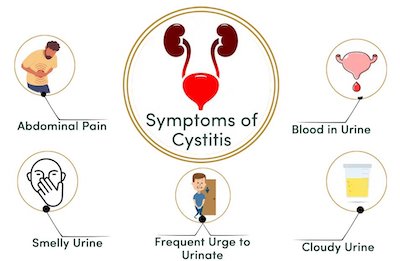 ما هي اعراض التهاب المثانة؟