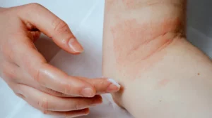 الاكزيما eczema