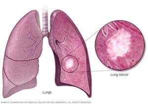 سرطان الرئة lung cancer
