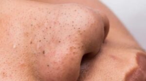 الرؤوس السوداء (Blackheads)