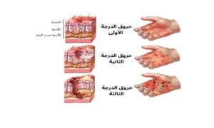 درجات الحروق